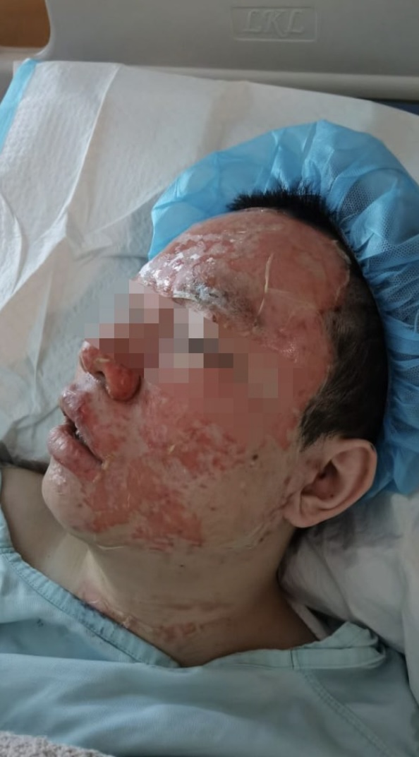 一名年僅21歲的男大學生慘遭二級燒傷恐毀容。