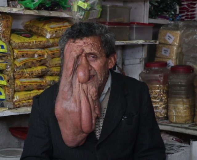 他是從20歲左右開始發現自己出現奇怪的症狀,當時候他的右臉頰長出了一顆類似小水泡的腫瘤,後來腫瘤越來越大。