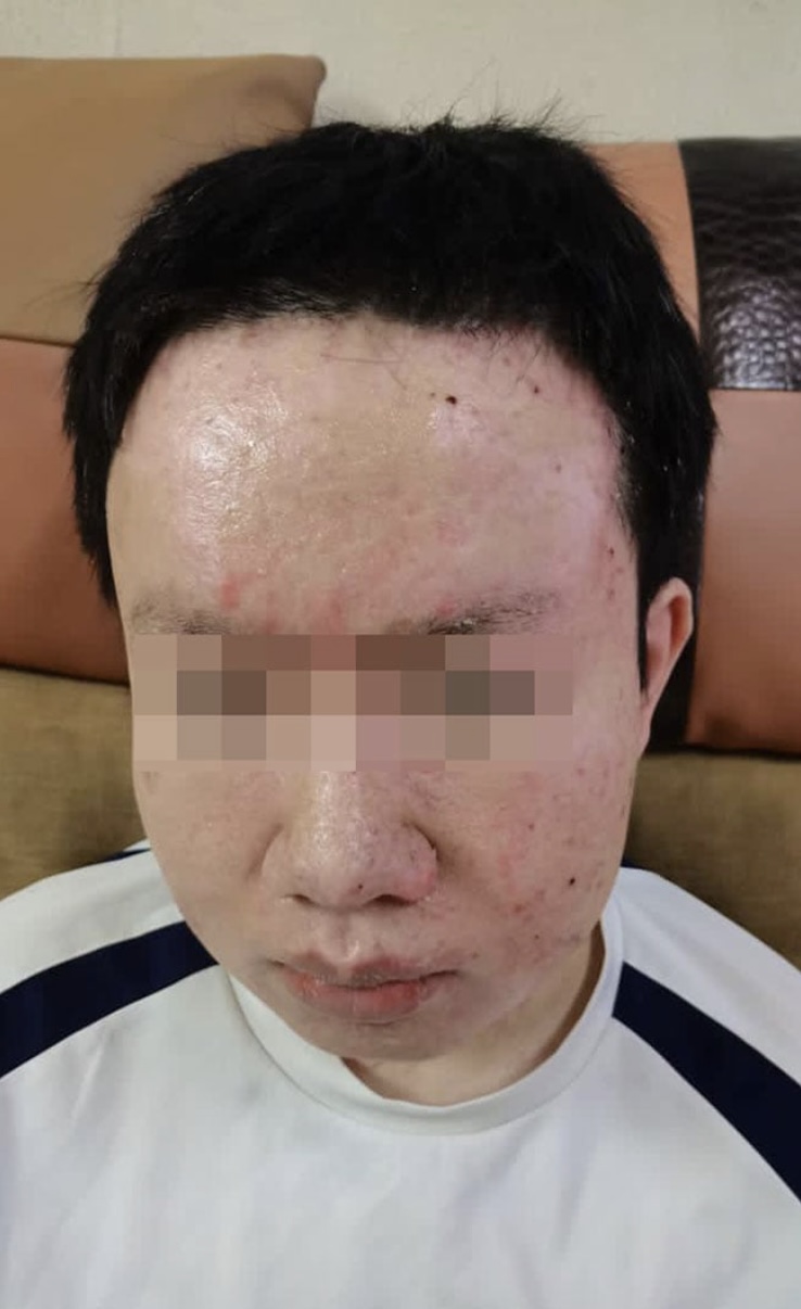 臉部恐永久留疤。