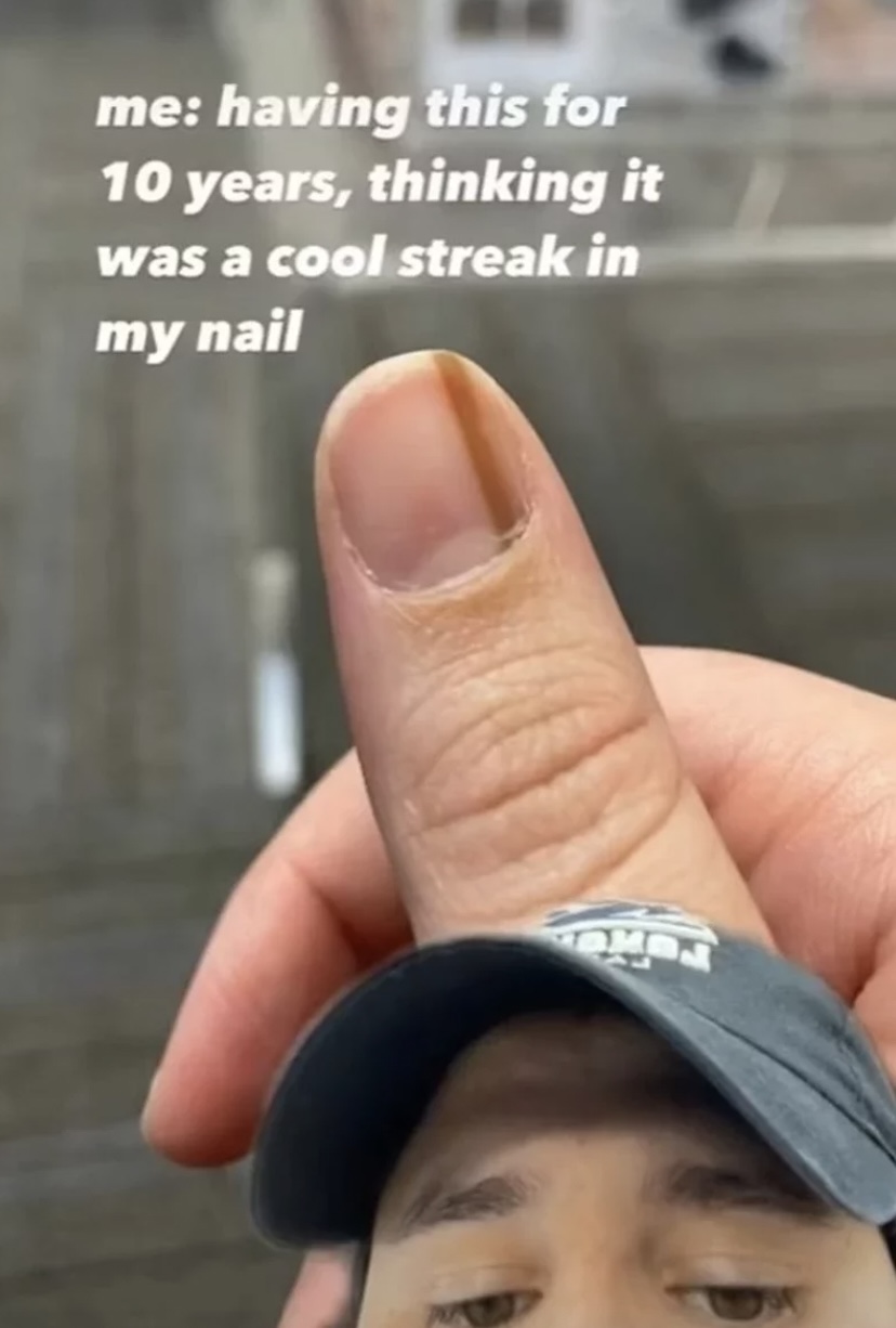 美國一名女子在TikTok上分享自己的指甲上有1條棕色直線。