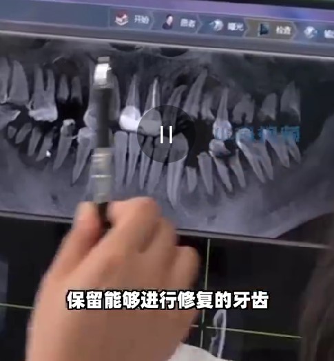 可樂内帶有碳酸，酸性物質會與牙齒内的鈣質產生反應。