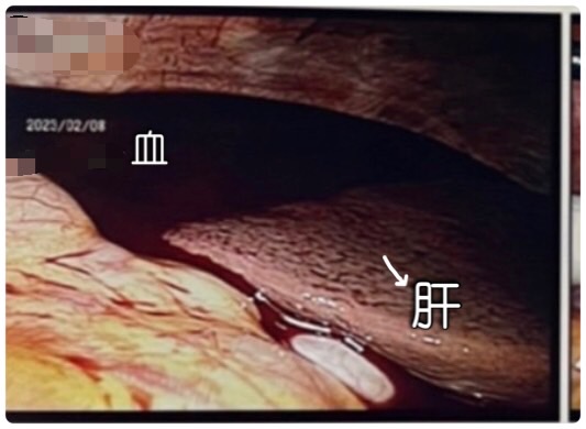 可見肝已經被血淹沒。