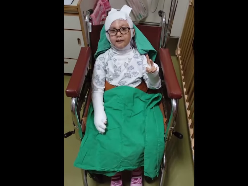 全身4成面積達2至3級燒傷。