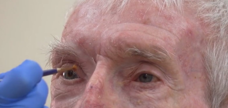 失去眼睛的患者。