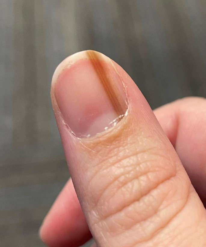 Maria表示在2012年12月就發現指甲上有1條棕色直線。