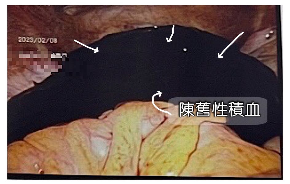 腹腔中有嚴重積血,而且肚子裏都是陳舊的暗黑色血塊和新鮮的血液。