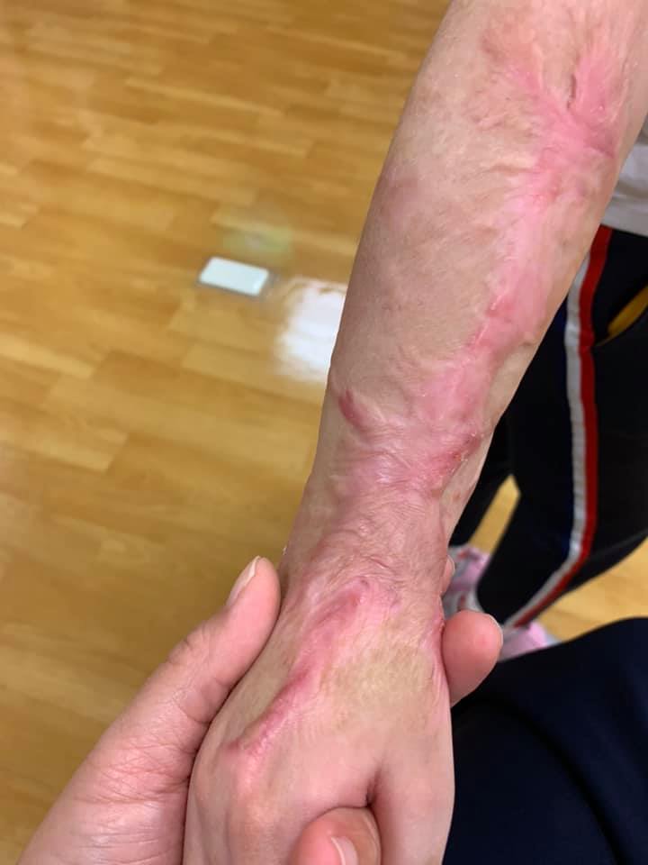 因疤痕增生需進行重建手術。