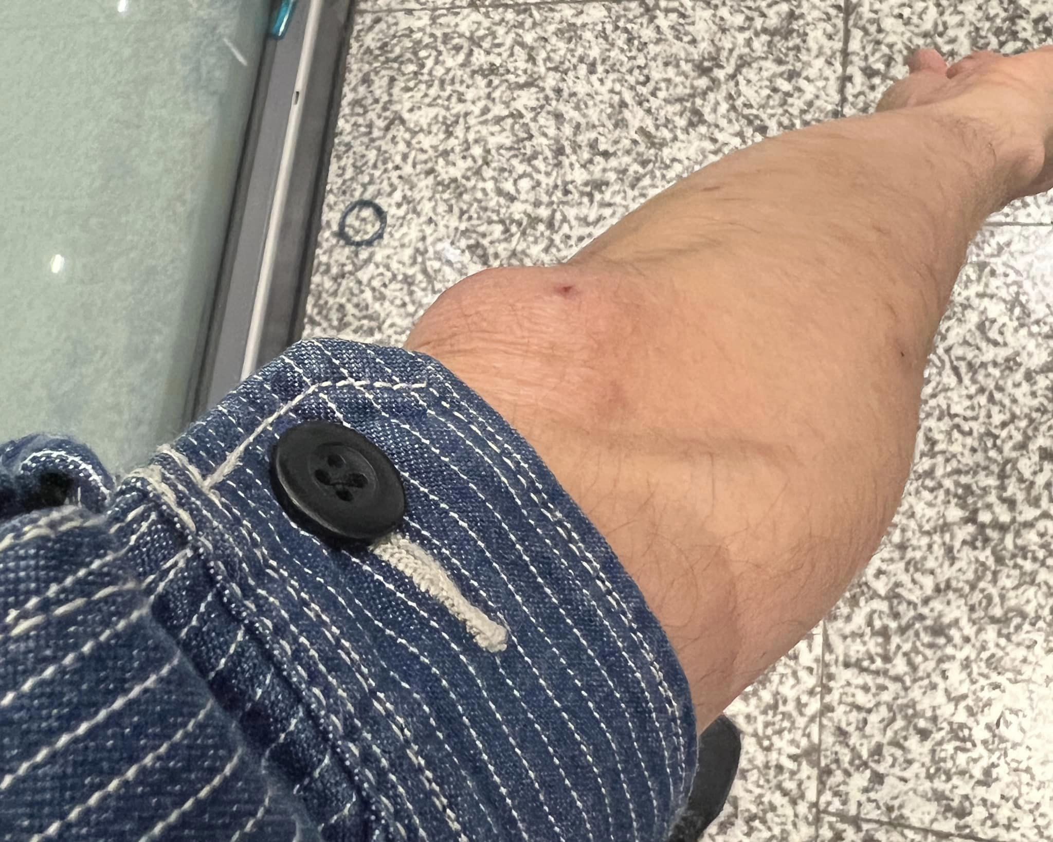 手肘肉眼可見的腫大。