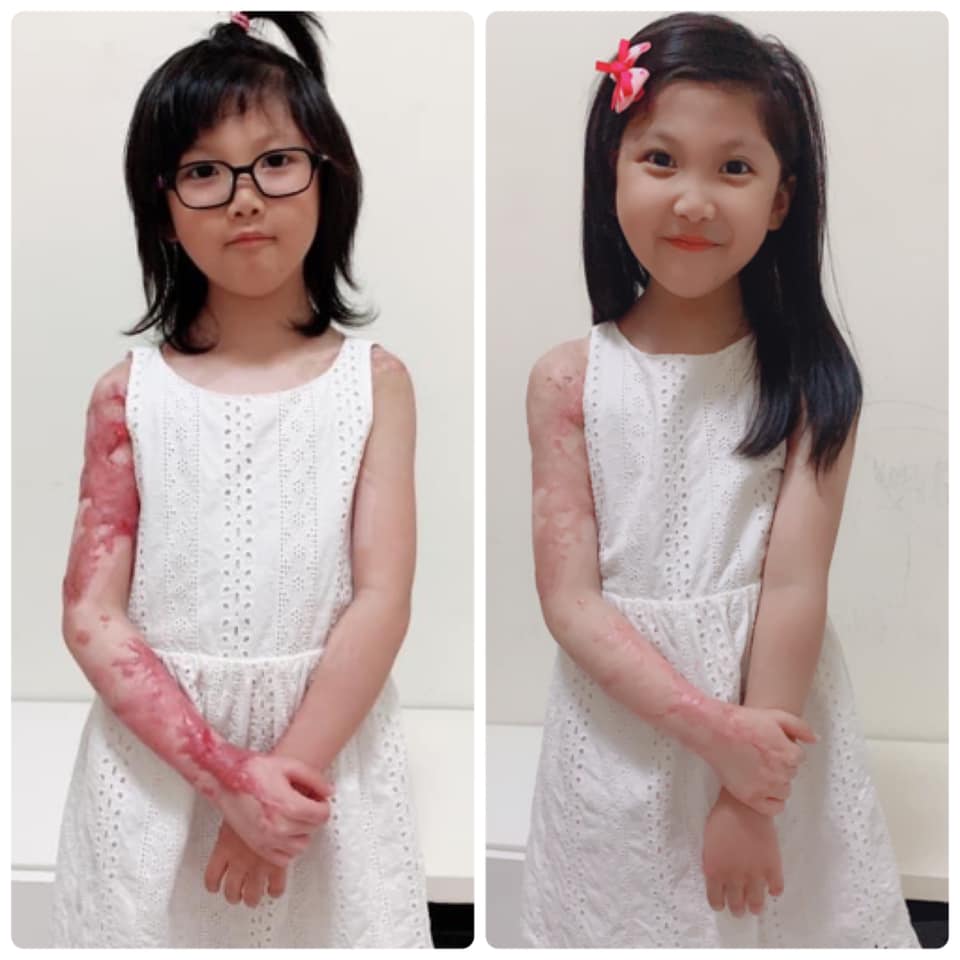 台灣一名11歲女童渝兒在4年前參加露營活動時不幸遇上意外,導致全身有4成被燒傷。
