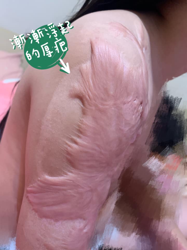 身上留下大片疤痕。