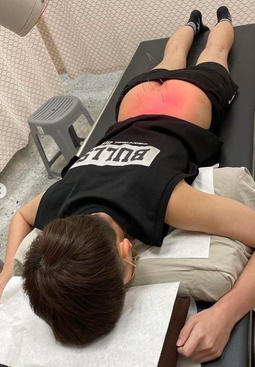 後來在照了X光後,確實了尾椎斷裂,而且傷口處嚴重發炎,醫生馬上為她準備高能量雷射復建治療。