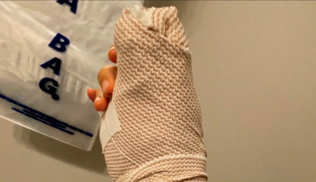 醫生為她切除整個甲床及拇指,及後又幫她完成植皮。