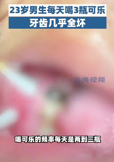 大部分的牙齒已經被腐蝕到爛，甚至波及牙齦。