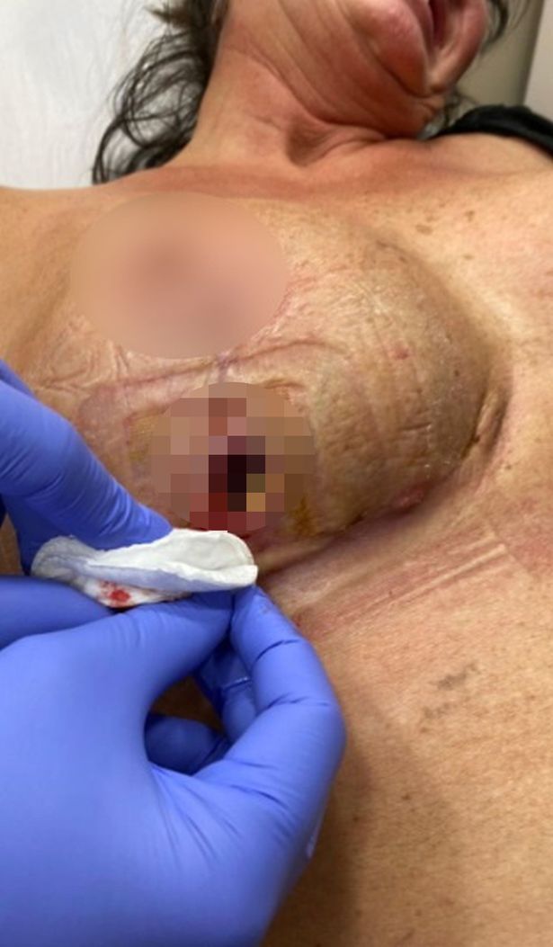 Kelly發現右乳房下方的傷口處破了一個恐怖大洞還流出濃液。