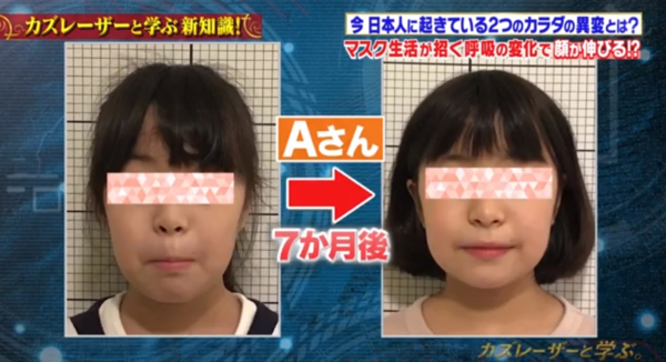 1名女童曾習慣用口呼吸,使其臉型變長,形似「馬面」