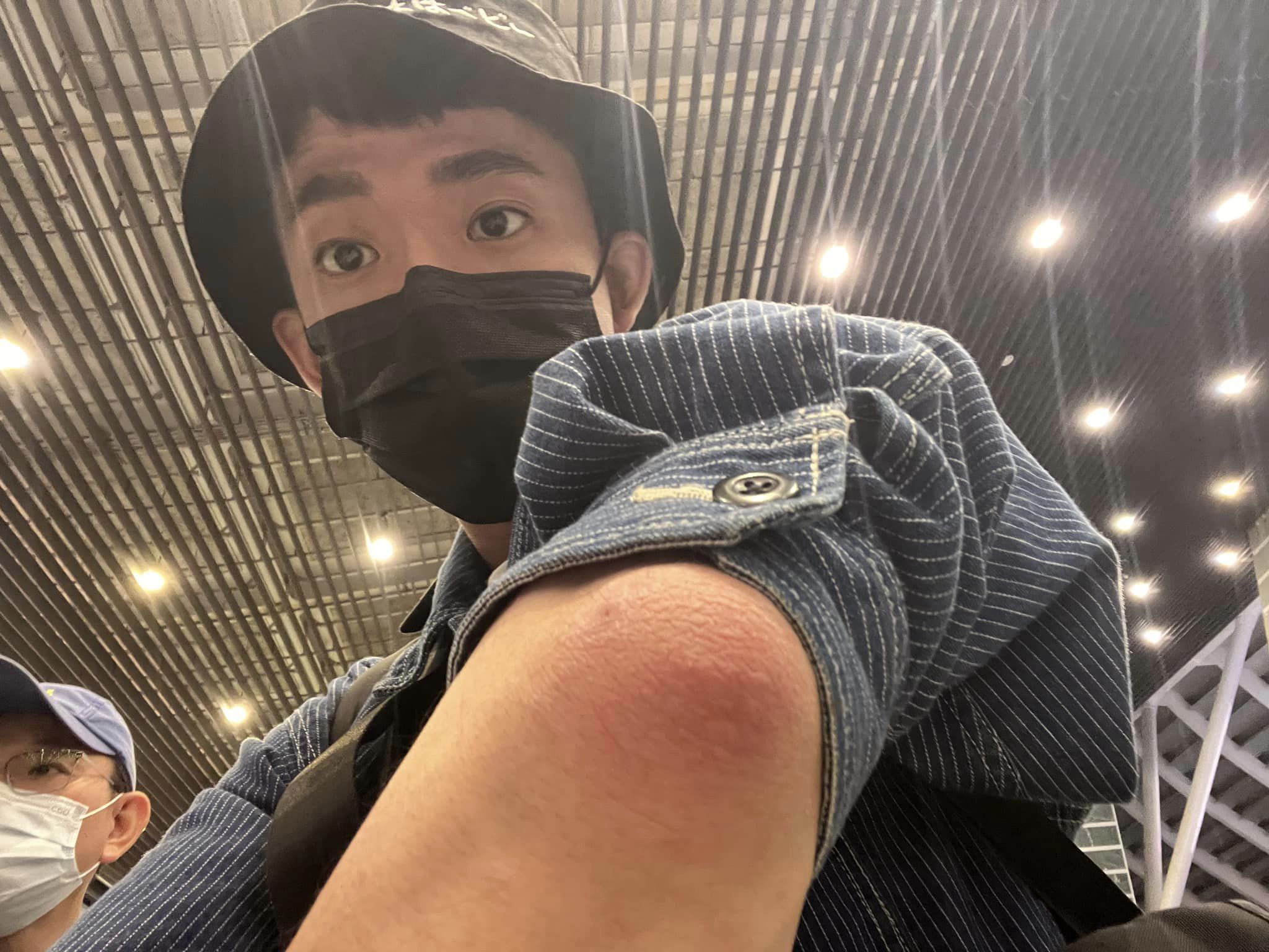 阿滴一起床就發現自己手肘腫大，起初以為只是撞到，結果不料越來越大，經檢查才知是痛風發作。