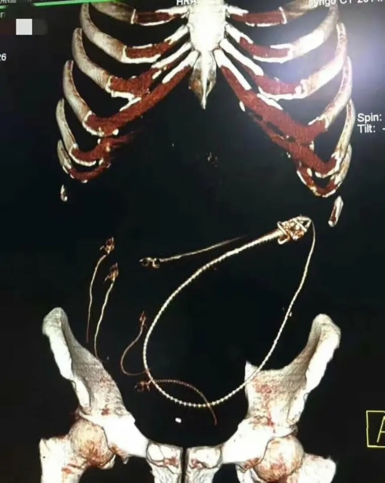 醫生發現男子結腸有一條鰻魚。