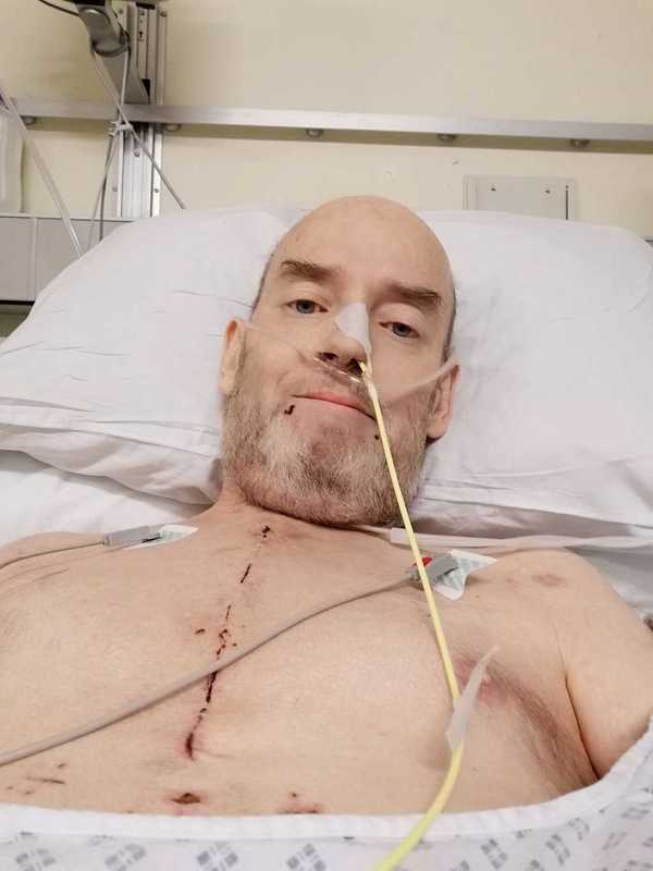 55歲男子Kevin Hill早前接受心臟瓣膜手術,怎料術後出現並發症「鈣化防禦症」(Calciphylaxis),令他非常難受。