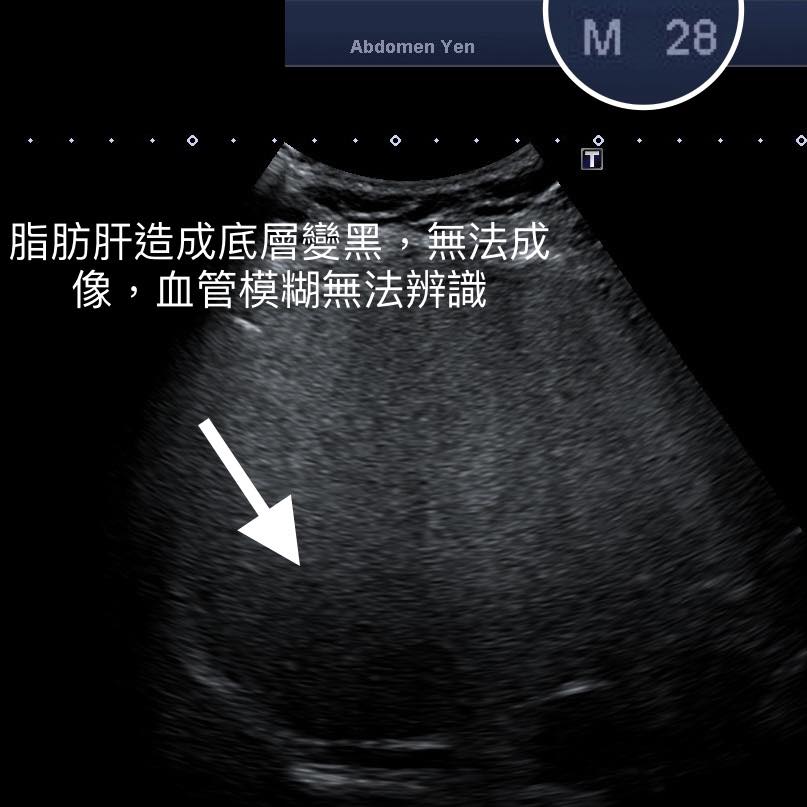 28歲青年的腹部超聲波顯示底層發黑,血管模糊無法辨認。