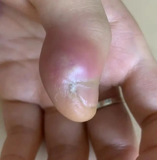 13歲數少年因常年咬指甲，10個指頭的指甲都已經破爛不堪。