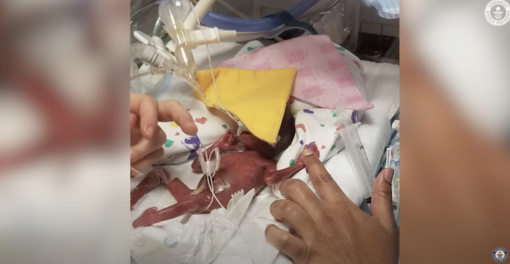 Adiah和Adrial是有史以來出生時最輕的雙胞胎,曾被醫生指存活率為0。