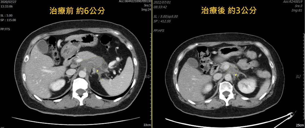 陳先生的腫瘤從3年前的6公分,變為現在的3公分,足足縮小了3公分。