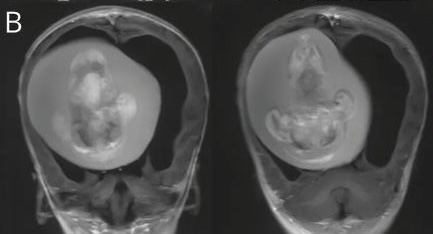 醫療團隊經檢查後發現女嬰的腦內竟然有一個約10公分的胎兒。