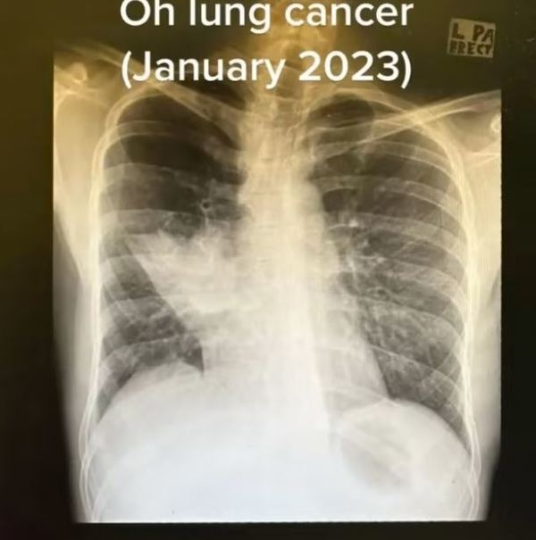 今年1月被診斷出罹患第三期肺癌。