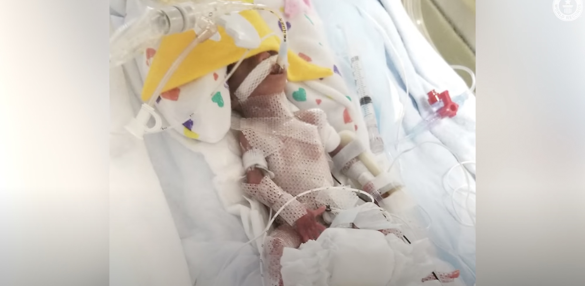 。雙胞胎出生後,身體非常瘦小只有手掌般大。