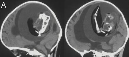 照片中可見胎兒的脊椎、上肢、骨骼似乎都已長出來了,不過未發育完整。
