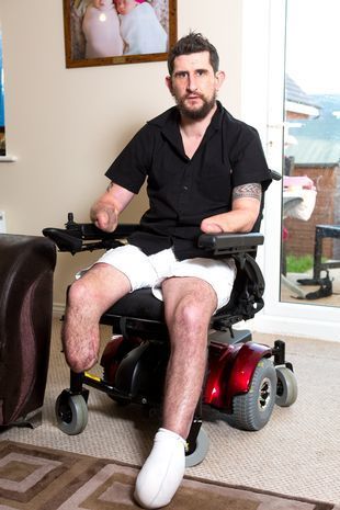 英國一名39歲的單親爸爸因嚴重意外失去四肢。