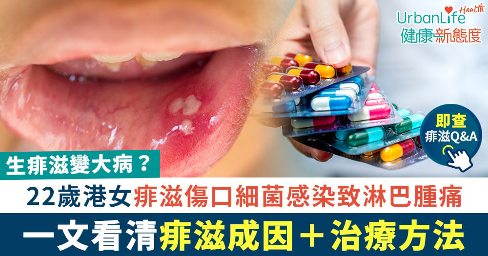 【生痱滋變大病?】傷口細菌感染致淋巴腫痛 即查痱滋成因+治療