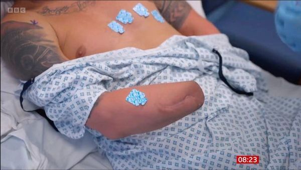 醒來後的他發現已被截去四肢。