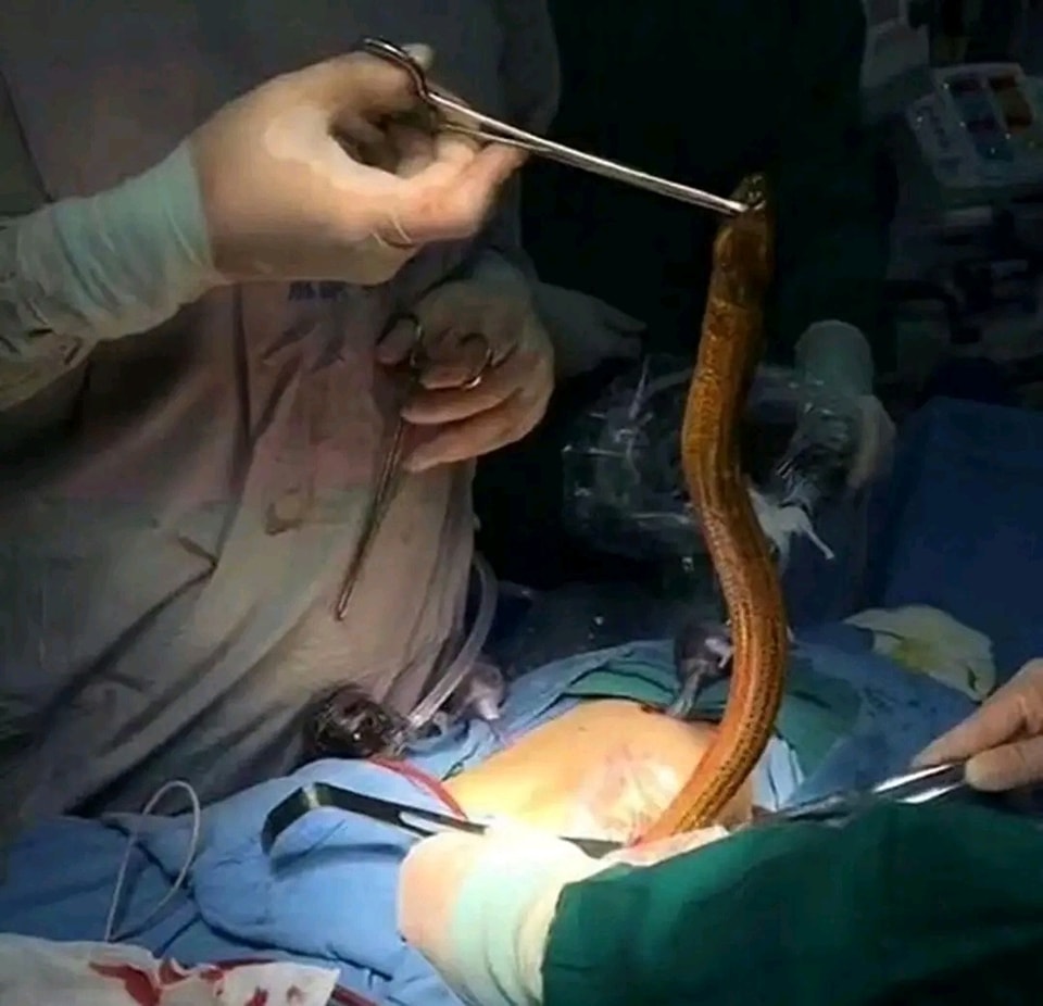 聽信偏方是把鰻魚塞入肛門可助排便。