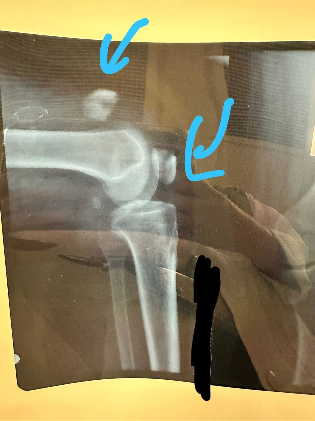 伯伯的膝蓋已經完全的碎裂，甚至傷勢嚴重需要開刀做手術。