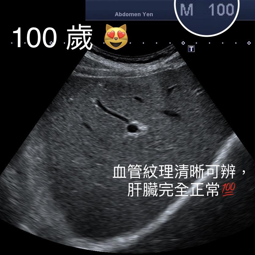 百歲老人的腹部超聲波顯示的肝臟顯示健康,血管紋理清晰可見。