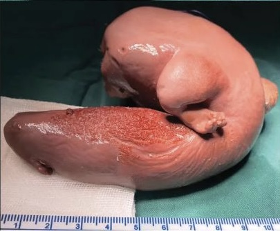 醫療團隊將女嬰腦中的胎兒取出。