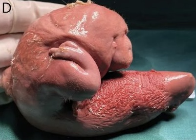 胎中胎(fetus in fetu)是一種在體內形成了類似胎兒的組織塊的發育異常。