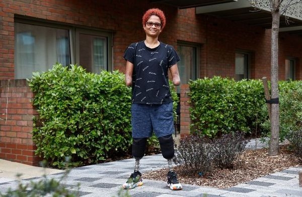 為免敗血症擴散到其他重要器官，醫生為她施行截肢手術。