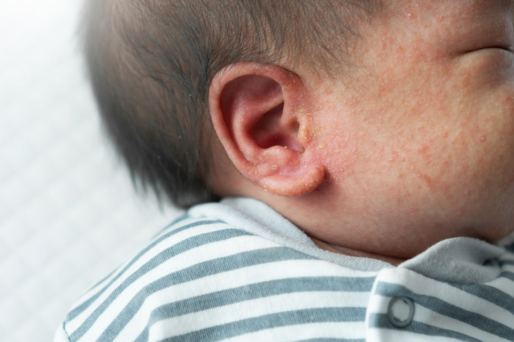 嬰兒(小於1歲)濕疹主要發生在頭皮和臉部,亦會出現在臉頰、軀幹及四肢,皮膚呈紅斑片狀