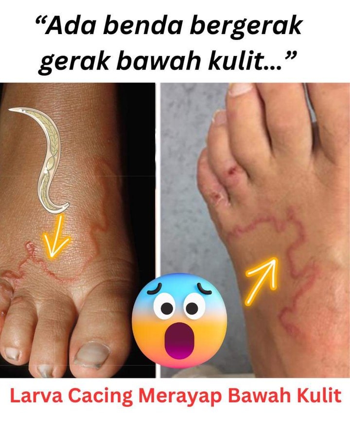 馬來西亞公共衛生(Public Health Malaysia)於近日分享一則真實病例,指出有一名女患者因被腳癢難忍困擾一周前來求醫。