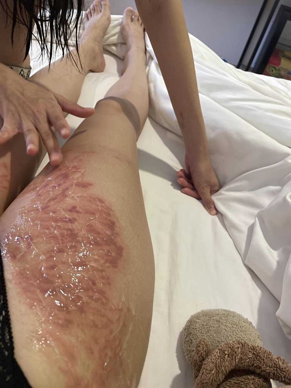 上岸後才發現自己的大腿已經紅腫嚴重,而且還伴隨著灼熱感,讓她痛不欲生。
