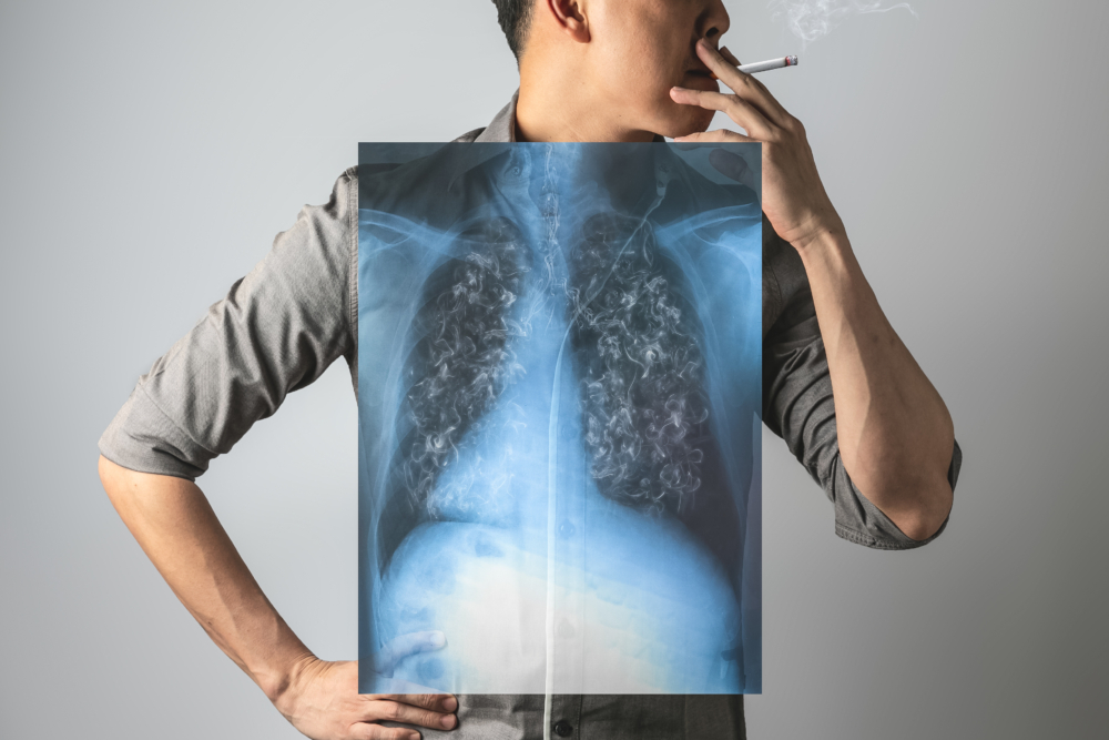 5大常見的肺癌成因有哪些?