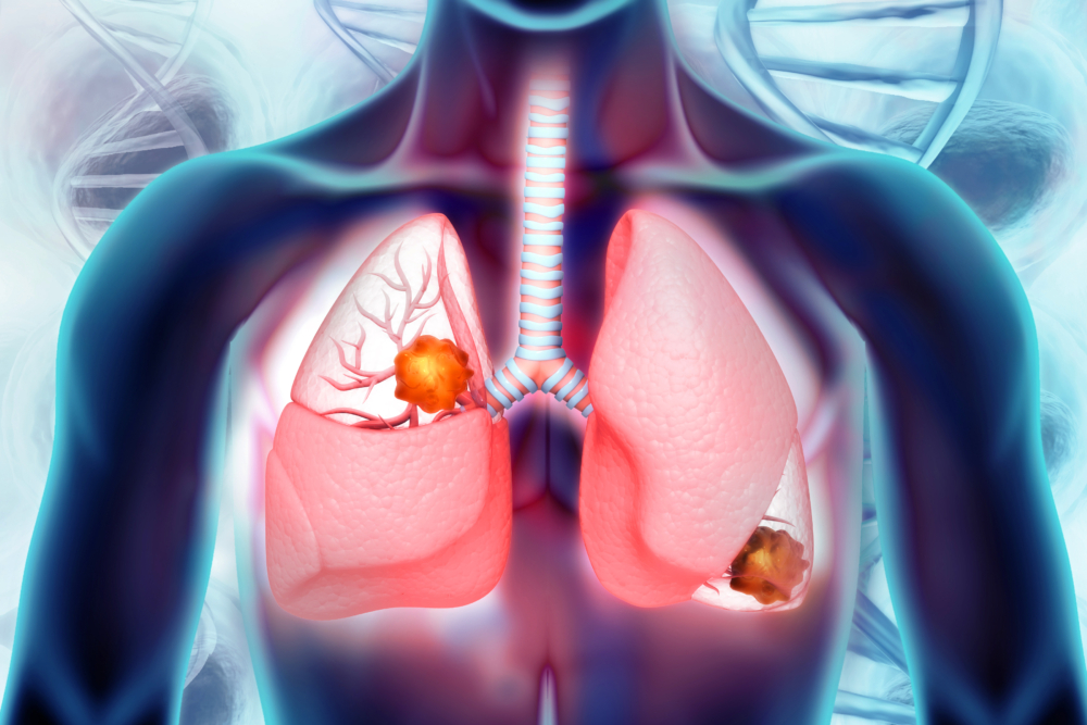 非小細胞肺癌(NSCLC)主要占據了整體肺癌的病例裏80%至90%,大多數患者都是因為在出現長期咳嗽、胸部感染、呼吸道感染、喘息、咳血等長期無法消除的症狀後被診斷患上非小細胞肺癌的。
