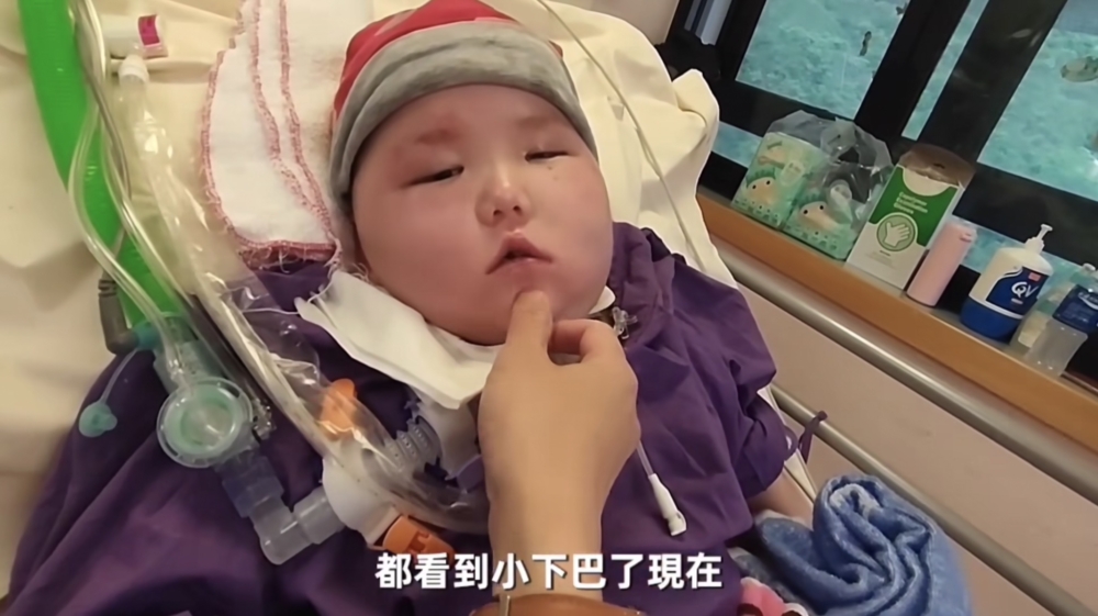 服用中藥後,可以看到天瑜的下巴了!
