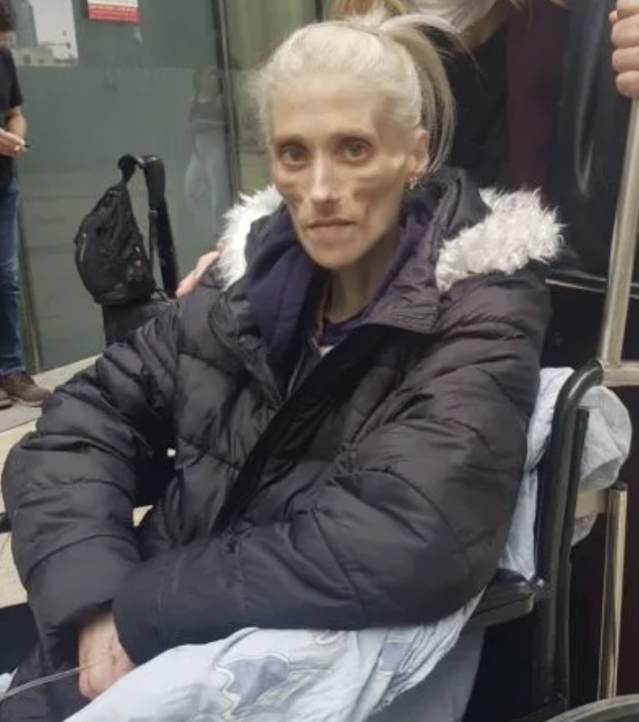 卡琳鮑曼與厭食症抗爭了10多年。