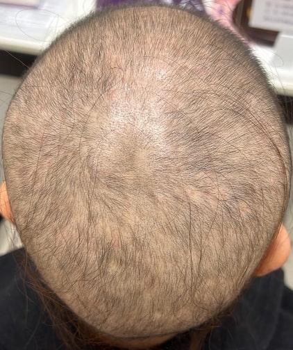 35歲單身女士,因為本身體型肥胖,想減肥希望尋找另一半,所以就瘋狂節食、吃減肥藥,雖然最後從70kg減到50kg,但期間月經停止,頭髮大片大片脫落。