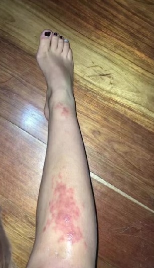 從沙灘回來後,發現腿上長滿了紅色小斑點。