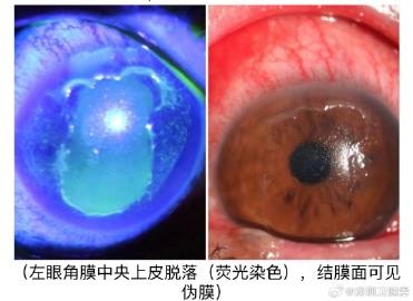 醫生發現該男子的眼睛角膜出現水腫,且左眼的視力也僅剩下0.05。