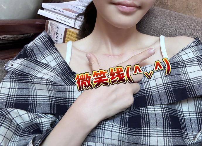 馮提莫曬出自己手術後的傷疤照。